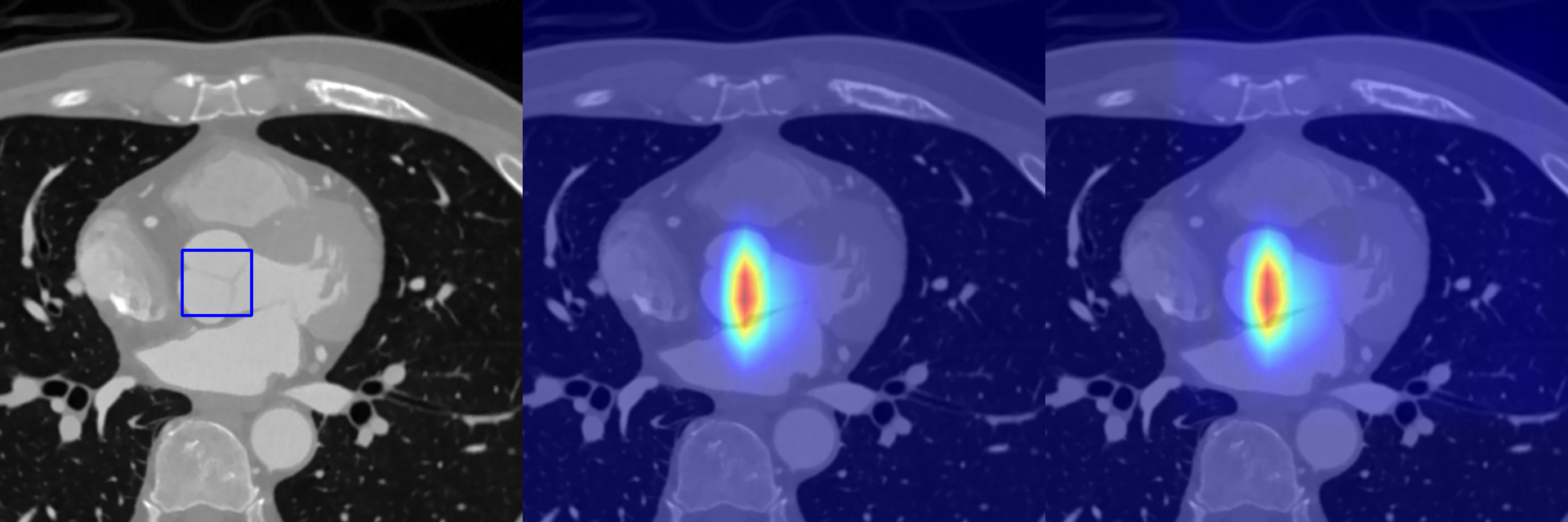 Comparison of the original CT image, Eigen-CAM, and Grad-CAM